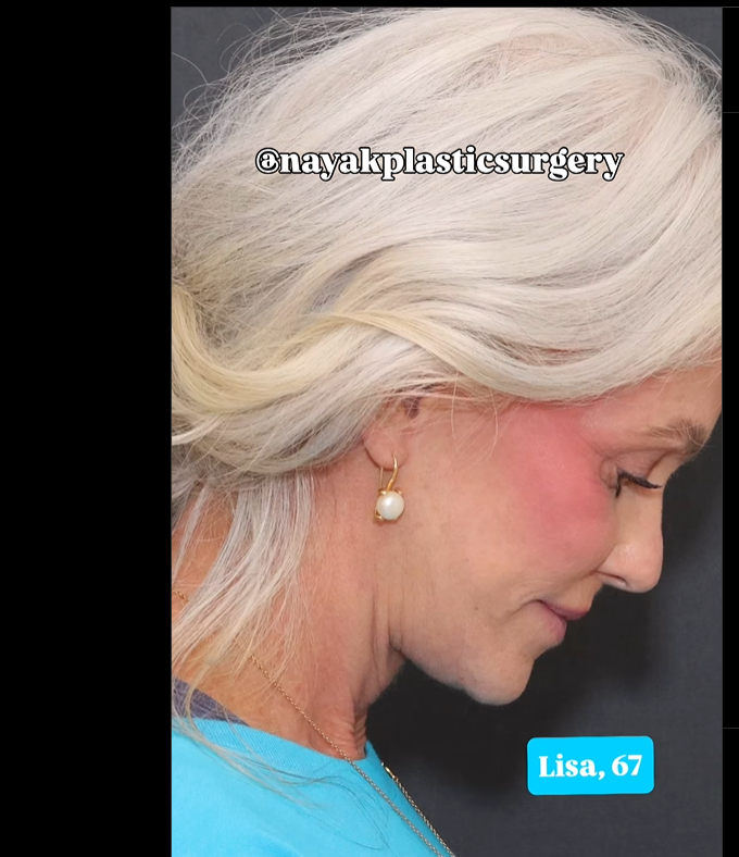 Lisa posiert nach dem Eingriff, zu sehen in einem Beitrag vom 1. Juni 2025 | Quelle: Instagram/nayakplasticsurgery