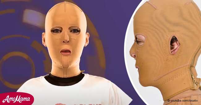 Eine Frau, die mehrere Jahre lang eine Kompressionsmaske tragen musste, zeigt endlich ihr Gesicht