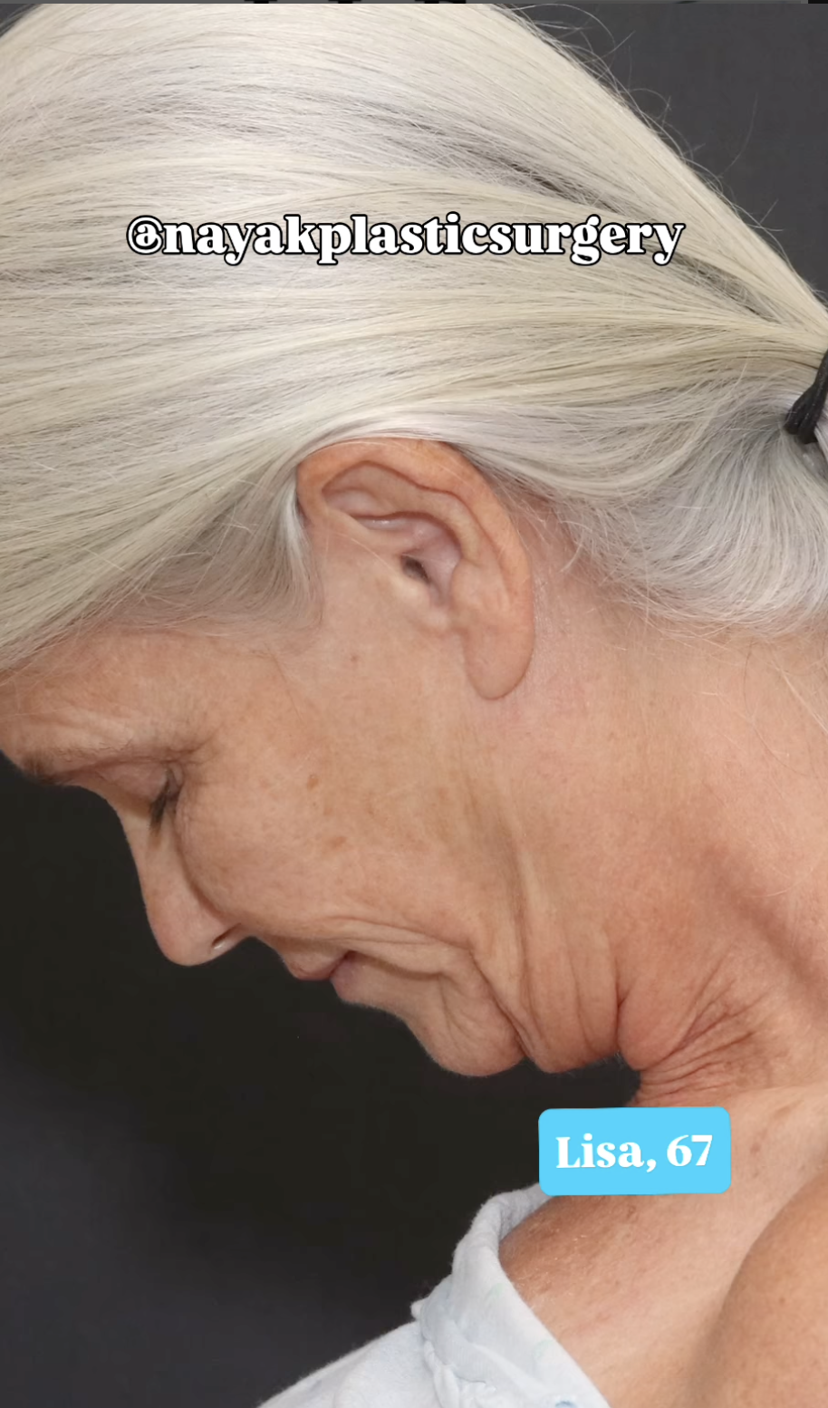 Lisa vor der Operation, vom 1. Juni 2025 | Quelle: Instagram/nayakplasticsurgery