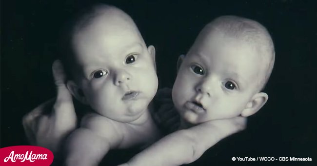 Siamesische Zwillinge wurden vor 12 Jahren erfolgreich getrennt und sie sind zu einzigartigen Persönlichkeiten geworden