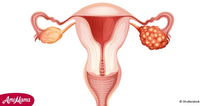 8 Anzeichen auf Eierstockkrebs, die jede Frau kennen sollte  