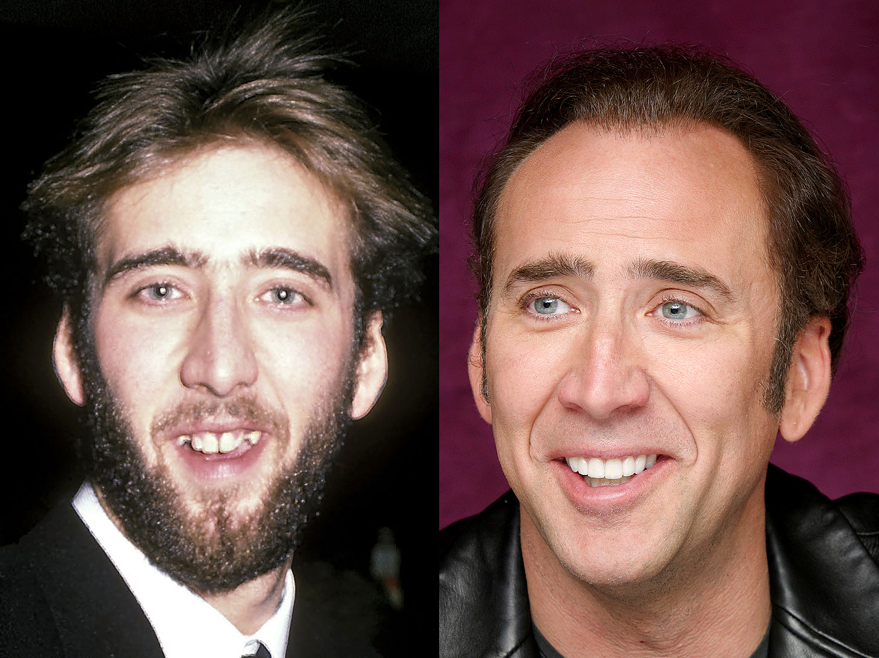 Ein Vorher-Nachher-Bild von Nicolas Cages Lächeln. | Quelle: Getty Images