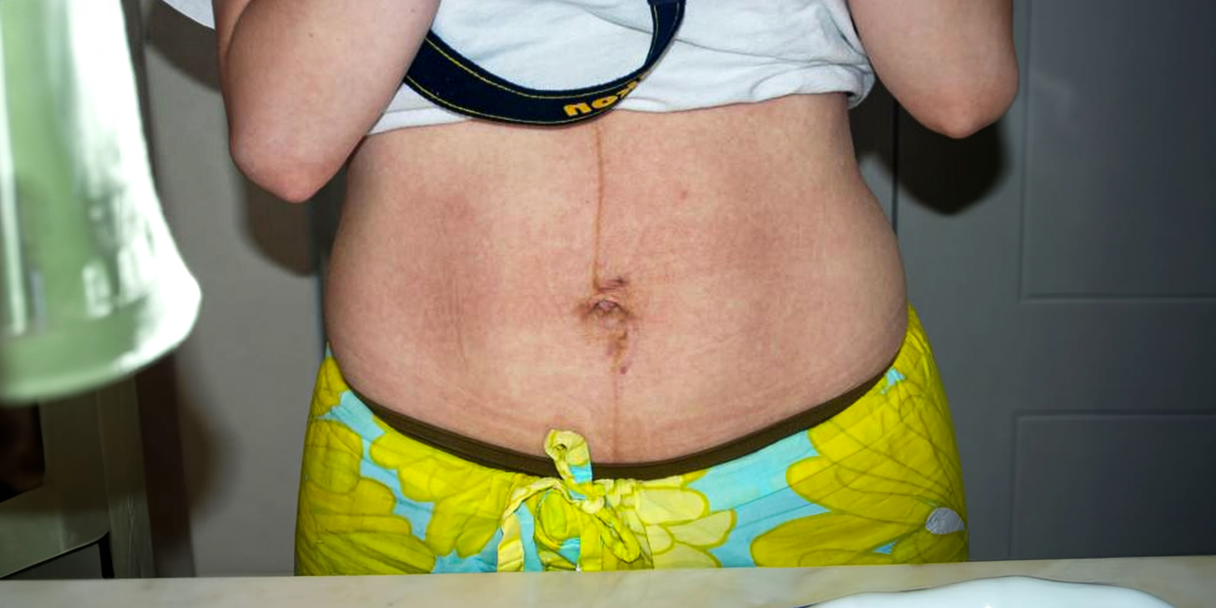 Der Bauch einer Frau mit Dehnungsstreifen | Quelle: Flickr