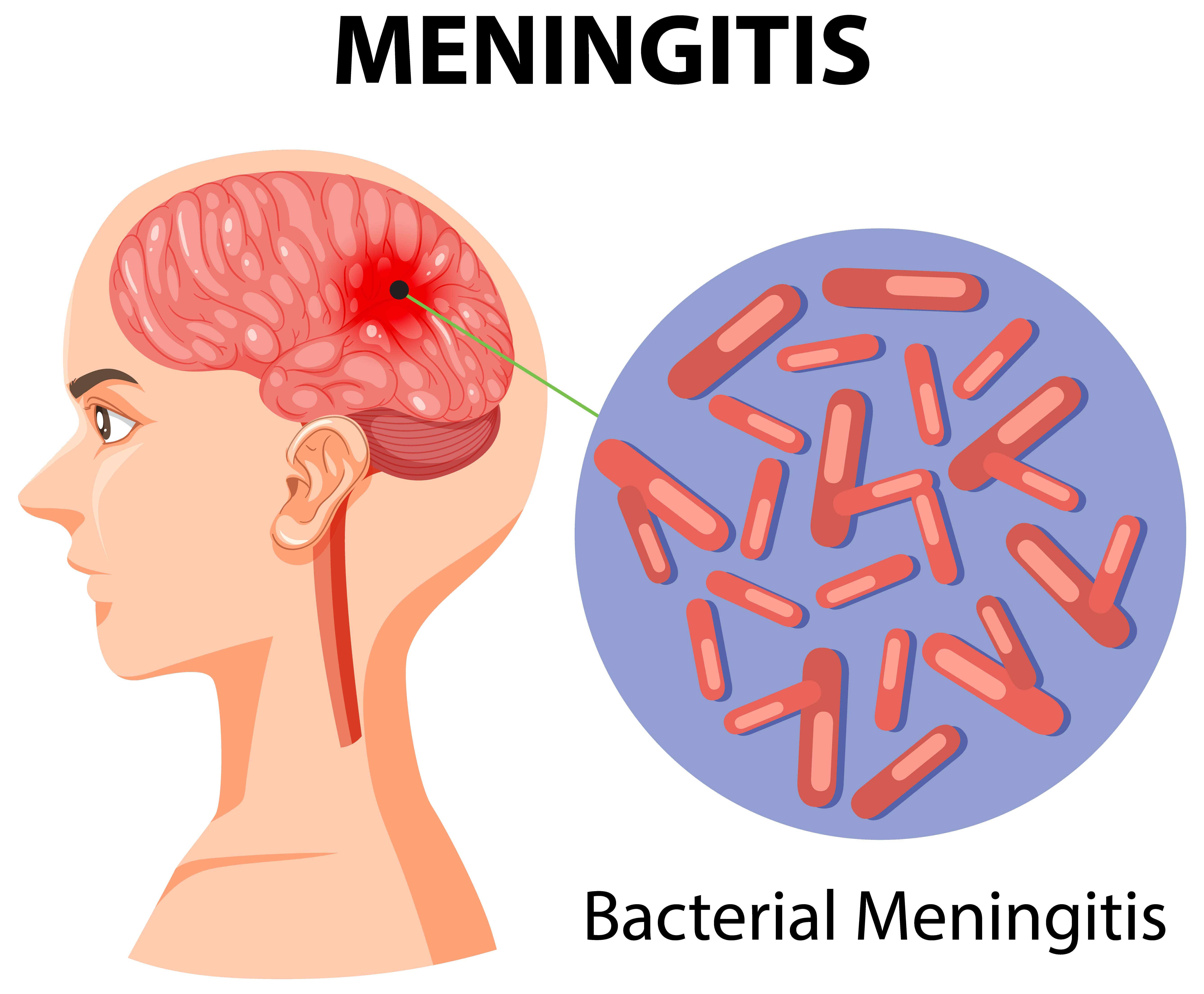 Diagramm eines mit Meningitis infizierten Gehirns | Quelle: Getty Images