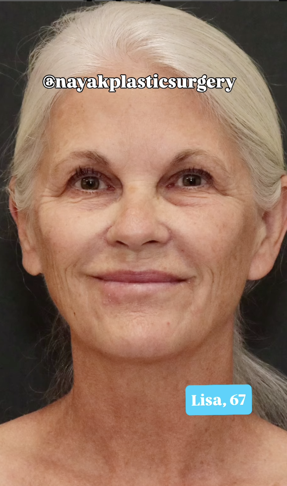 Lisa vor der plastischen Operation, vom 1. Juni 2025 | Quelle: Instagram/nayakplasticsurgery