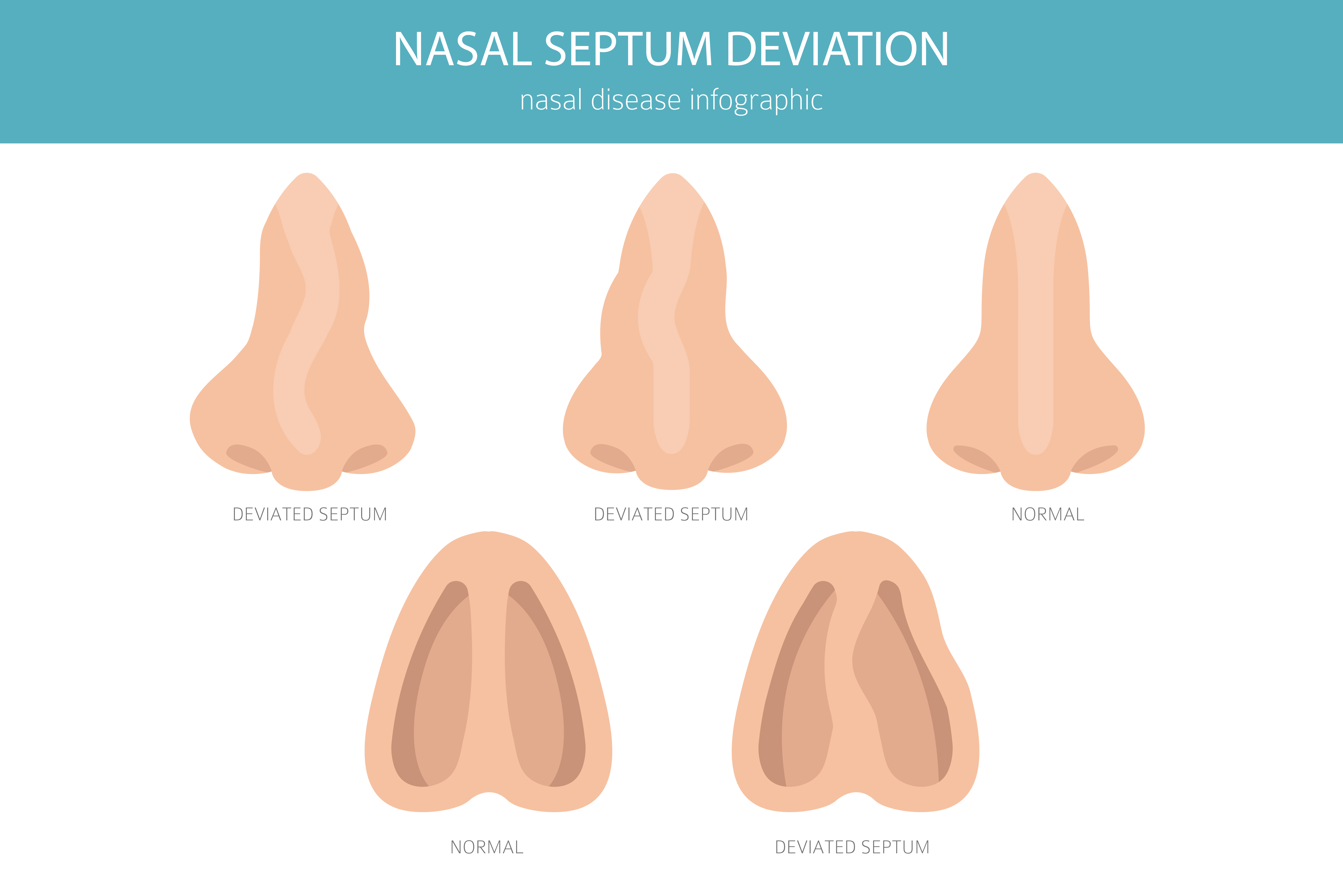 Eine Vektorillustration einer Nase mit Septumdeviation | Quelle: Getty Images