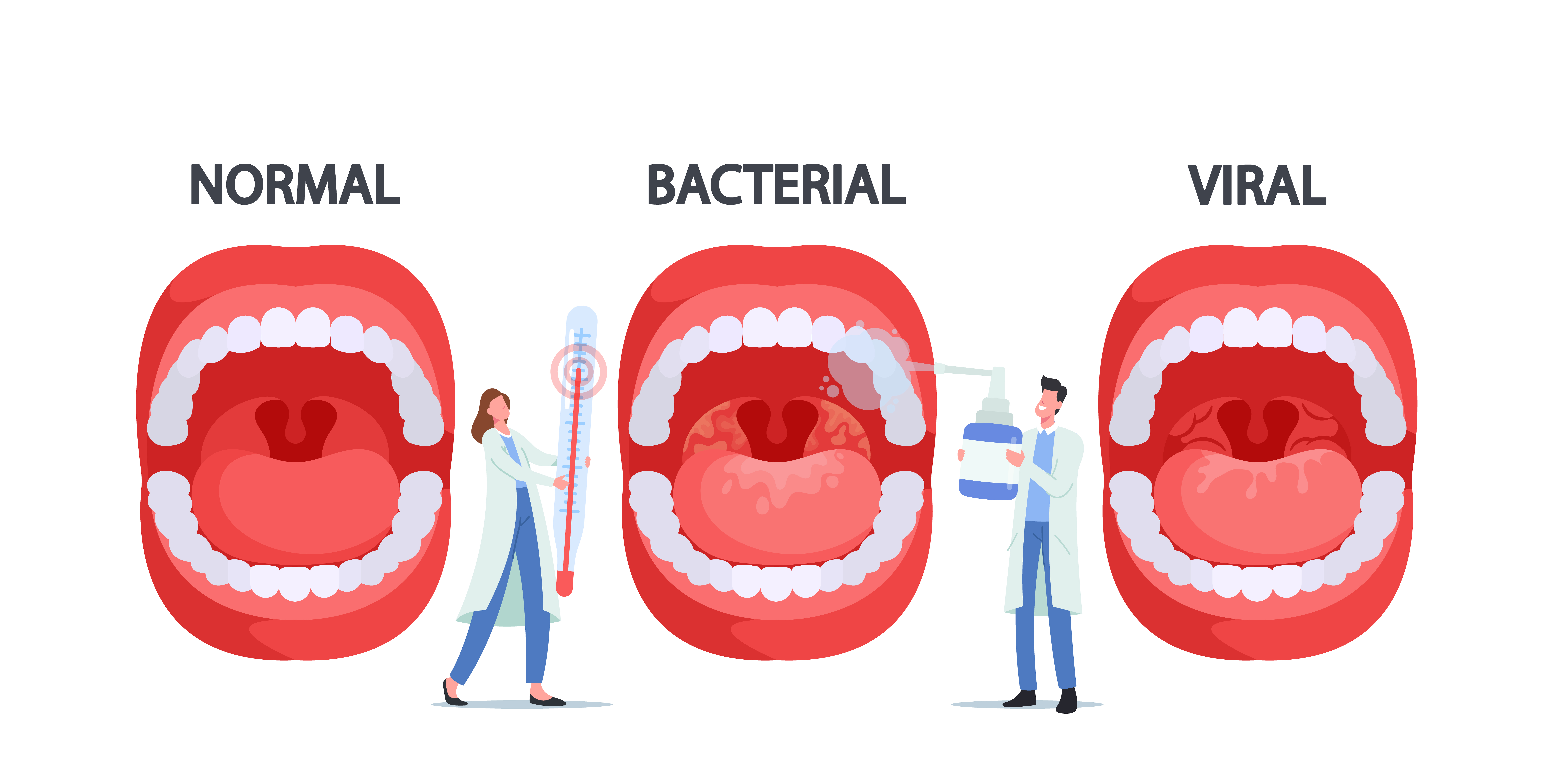 Vektor-Illustration, die eine Infektion mit dem Bakterium Streptococcus Thermophilus zeigt | Quelle: Getty Images