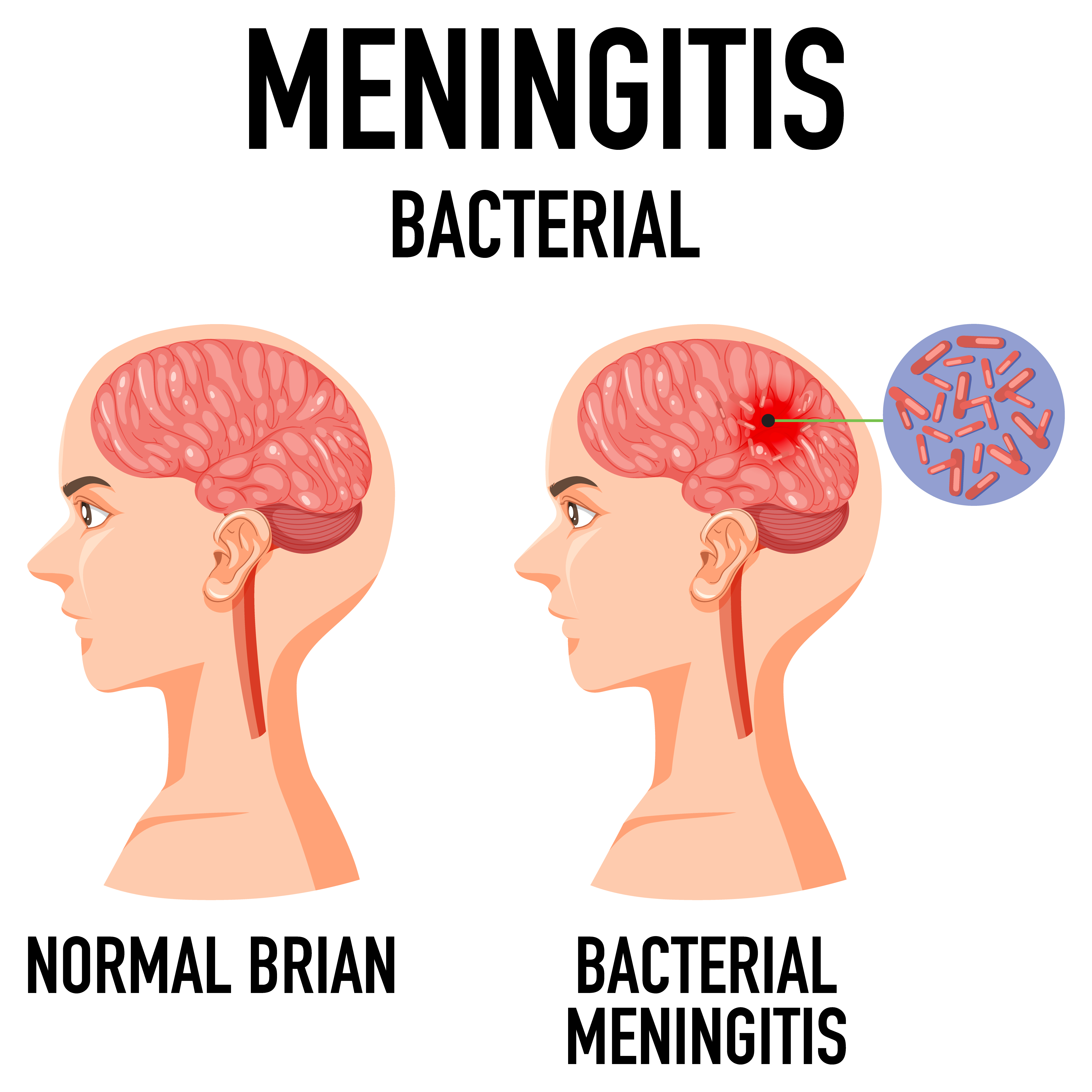 Diagramm zur bakteriellen Meningitis | Quelle: Getty Images