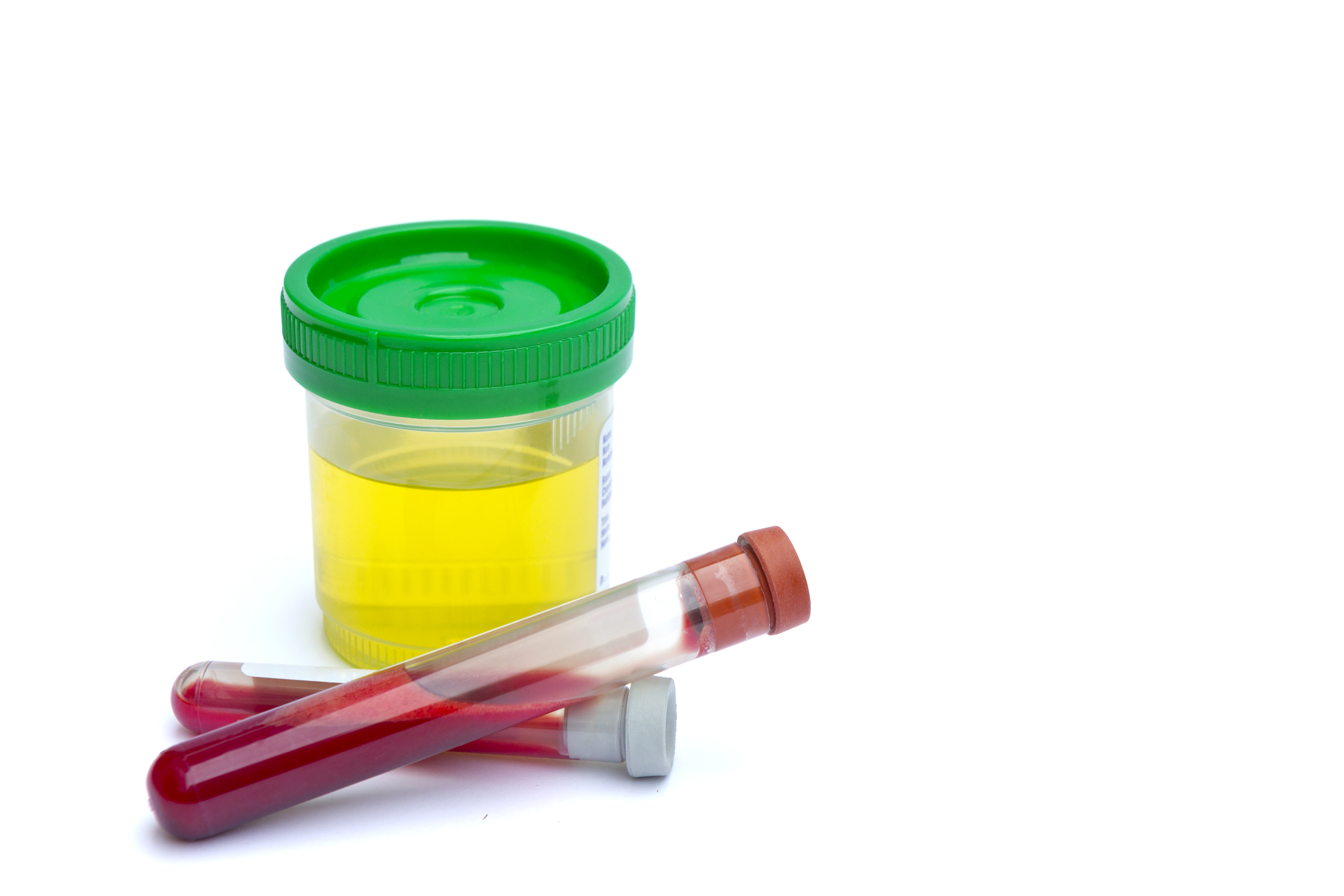 Sterile Urin- und Blutprobengefäße in einer klinischen Umgebung | Quelle: Getty Images