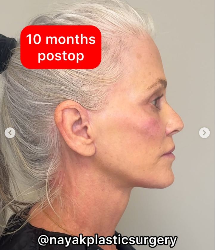 Lisa nach der Operation, aus einem Beitrag vom 4. April 2025 | Quelle: Instagram/nayakplasticsurgery