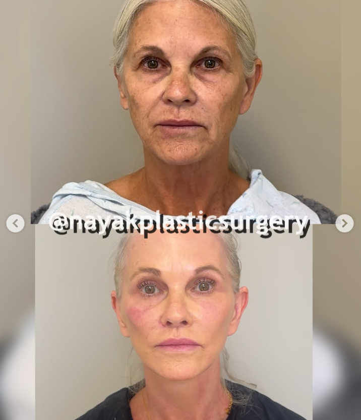 Lisas Vorher-Nachher-Bilder, aus einem Beitrag vom 4. April 2025 | Quelle: Instagram/nayakplasticsurgery
