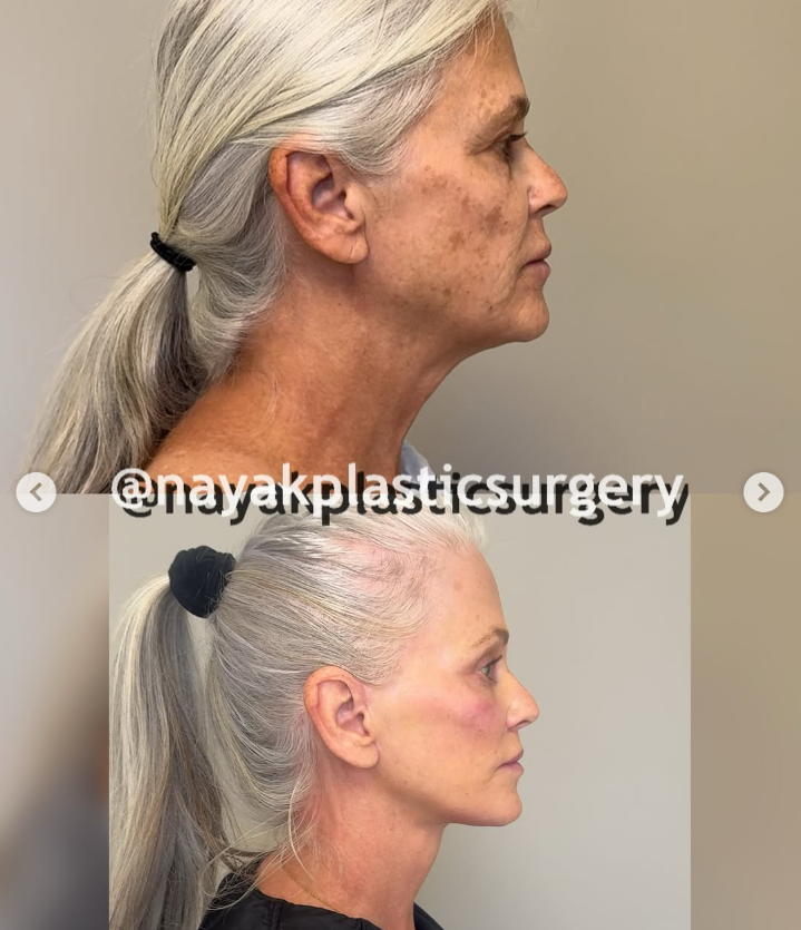 Lisas Vorher-Nachher-Bilder, aus einem Beitrag vom 4. April 2025 | Quelle: Instagram/nayakplasticsurgery