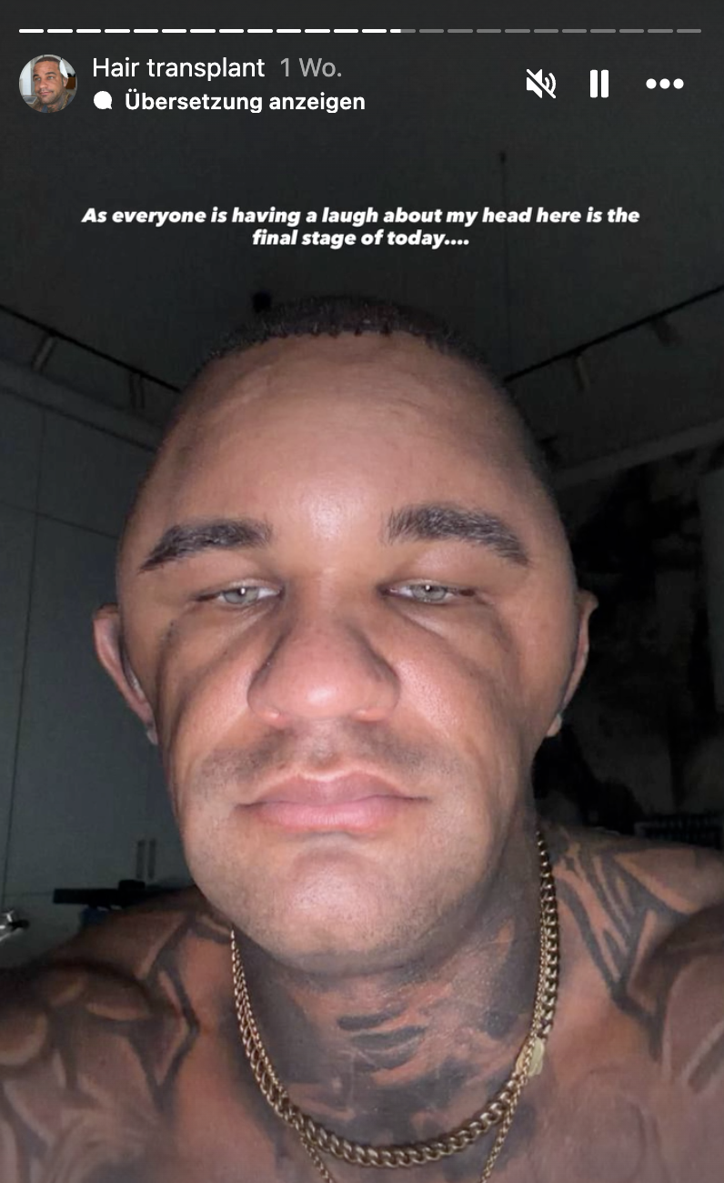 Max Jacobasch zeigt auf Instagram die Schwellungen nach seiner Haartransplantation | Quelle: Instagram/max_jacobasch