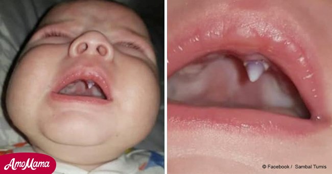 Die Eltern und Ärzte schockiert: Ein Baby bekommt in einer Nacht einen Vampirzahn