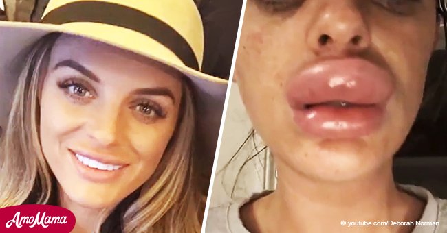 Eine Frau verlor fast ihre Lippen, nachdem Botox sie zweimal größer gemacht hatte