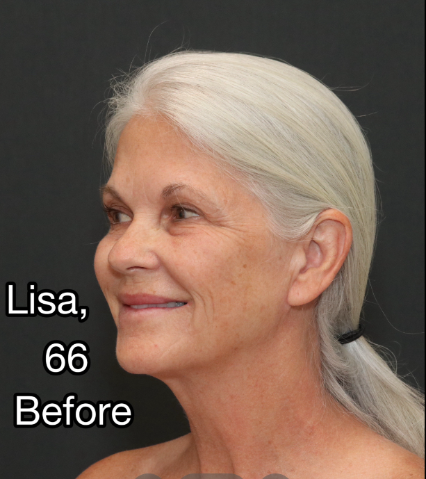 Lisa posiert vor den Eingriffen, vom 3. April 2025 | Quelle: TikTok/@nayakplasticsurgery