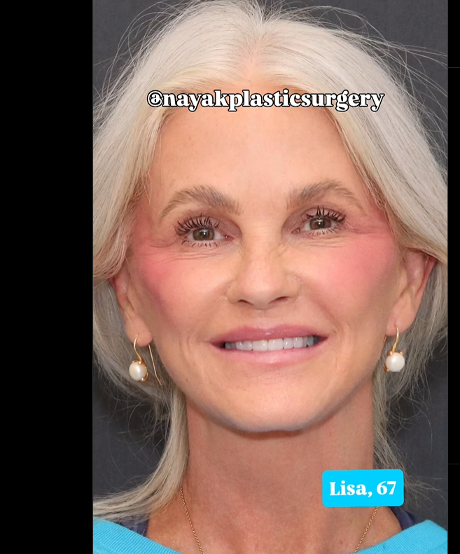 Lisa lächelt nach der Operation in die Kamera, zu sehen in einem Beitrag vom 1. Juni 2025 | Quelle: Instagram/nayakplasticsurgery