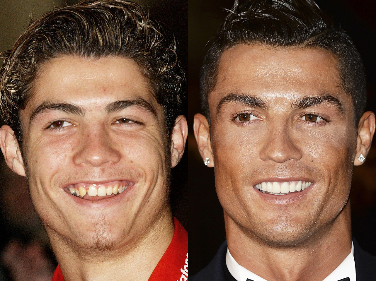 Ein Vorher-Nachher-Bild von Cristiano Ronaldos Lächeln. | Quelle: Getty Images