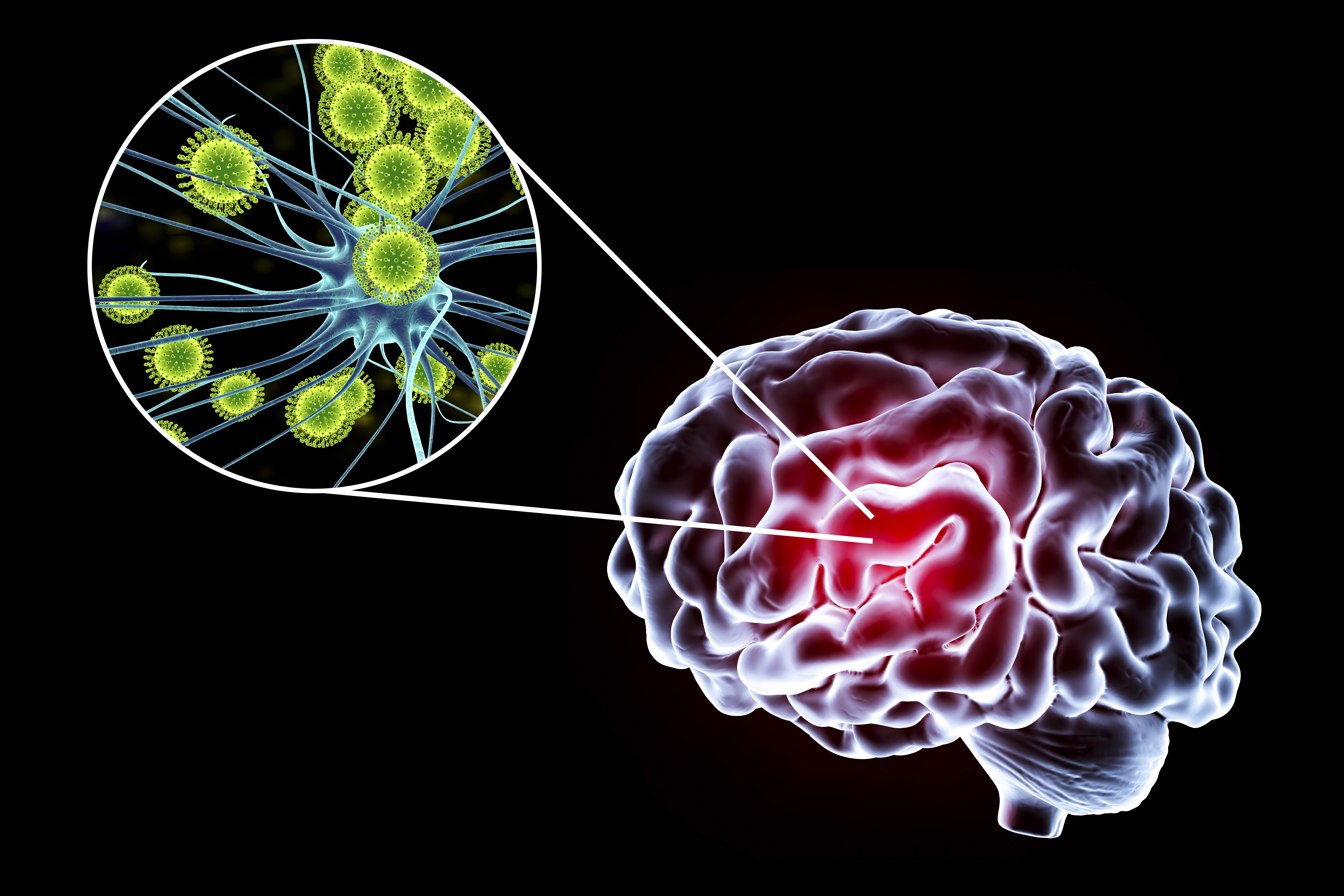 Konzeptuelle Illustration des Gehirns und Nahaufnahme von Viren, die Neuronen infizieren | Quelle: Getty Images