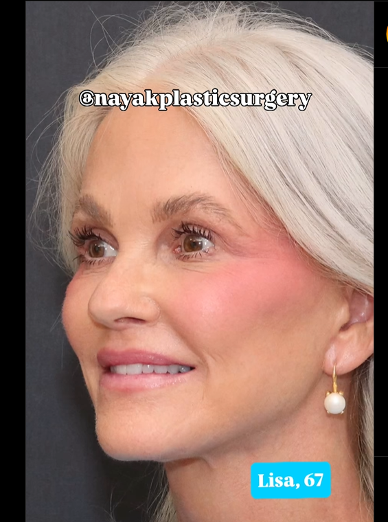 Lisa nach der Operation, wie in einem Beitrag vom 1. Juni 2025 zu sehen | Quelle: Instagram/nayakplasticsurgery