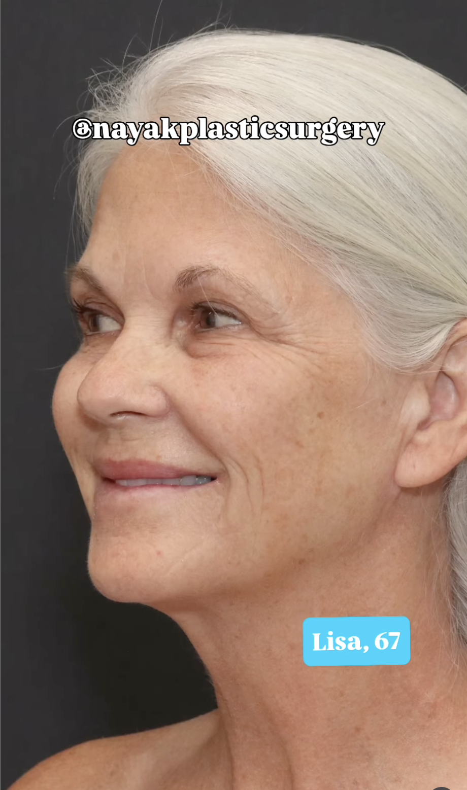 Lisa vor der Operation, zu sehen in einem Beitrag vom 1. Juni 2025 | Quelle: Instagram/nayakplasticsurgery