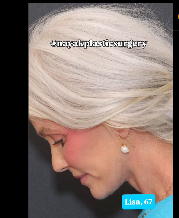 Lisa posiert nach der Operation, wie in einem Beitrag vom 1. Juni 2025 zu sehen ist | Quelle: Instagram/nayakplasticsurgery