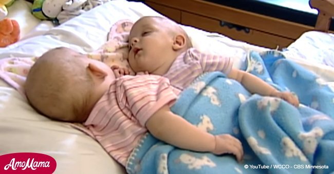 Diese siamesischen Zwillinge wurden als Babys getrennt. 10 Jahre später sehen sie sehr unterschiedlich aus